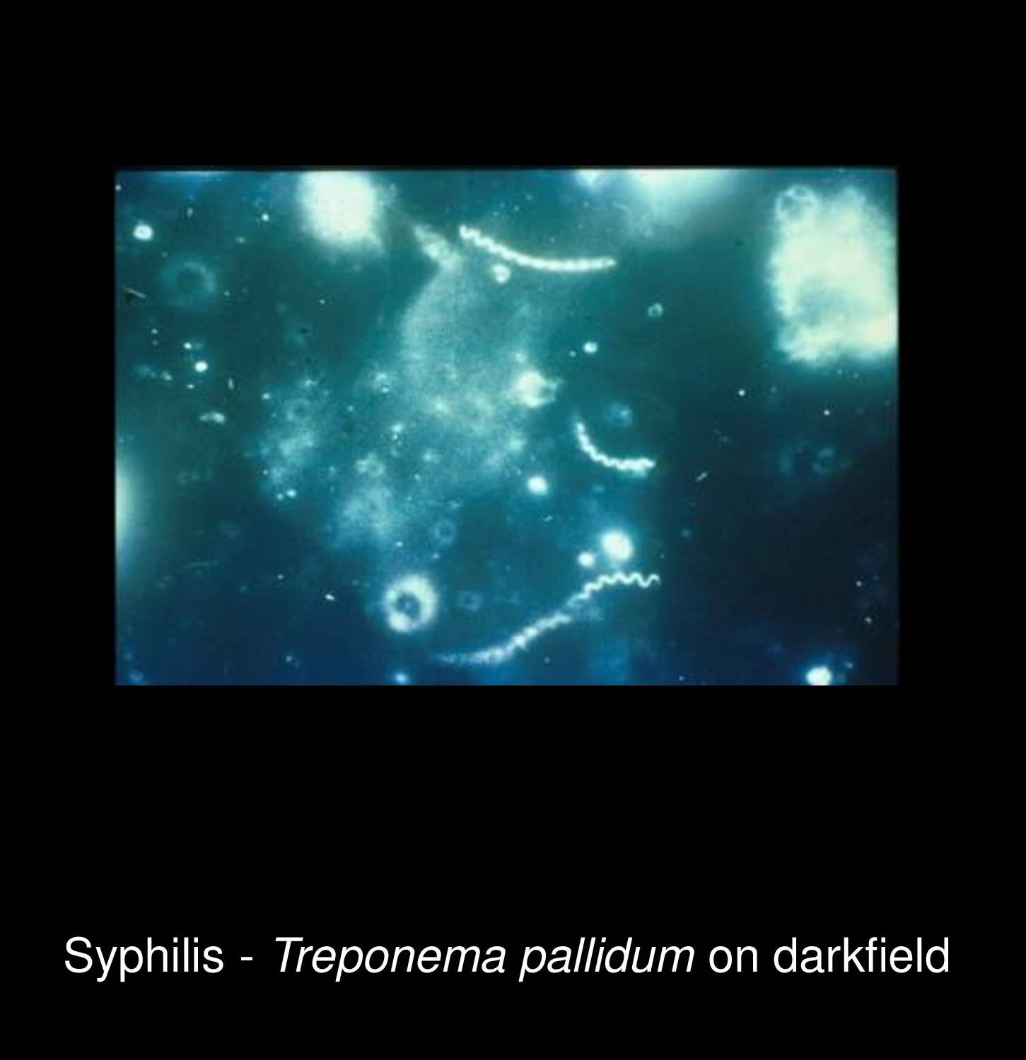 Secondary syphilis maculopapular rash on trunk showing generalized copper-colored papulosquamous lesions with characteristic distribution pattern